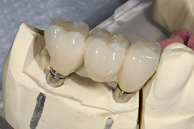 Dental bridge from lab iStock 000057401644 Large 400px